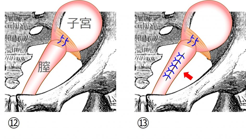 子宮脱 膀胱瘤の手術 メッシュを使わない方法