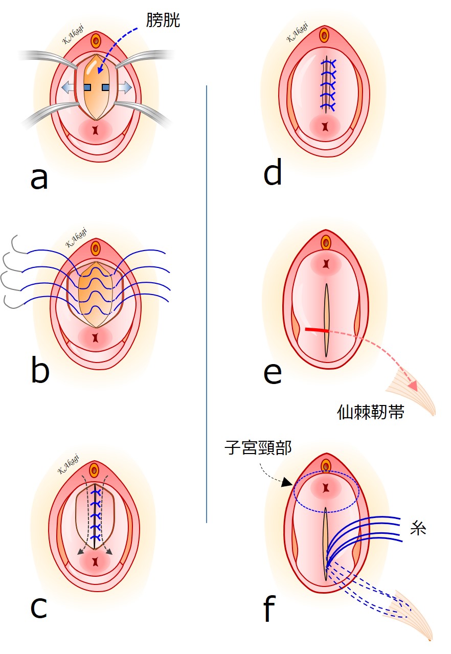 子宮脱 膀胱瘤 まとめ よくわかる骨盤臓器脱