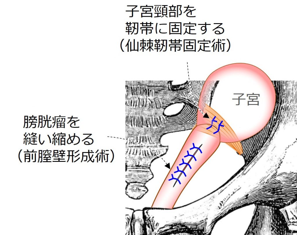 子宮脱 膀胱瘤 まとめ