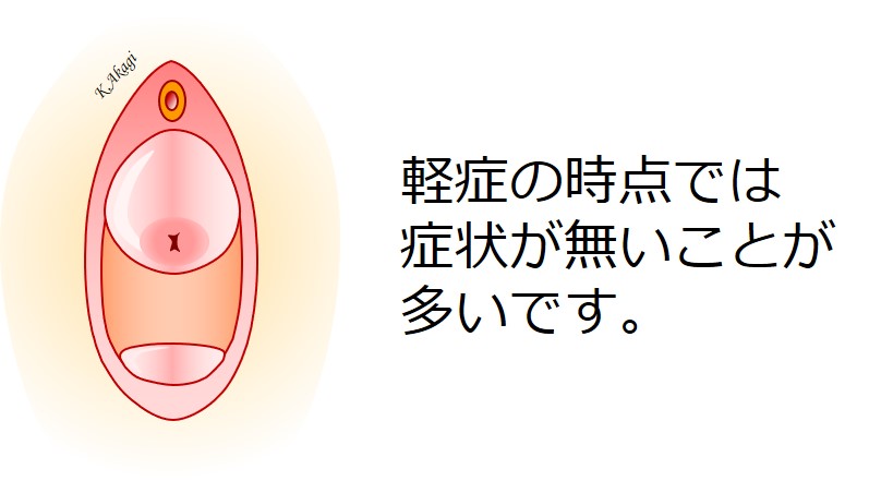 子宮脱 膀胱瘤の症状