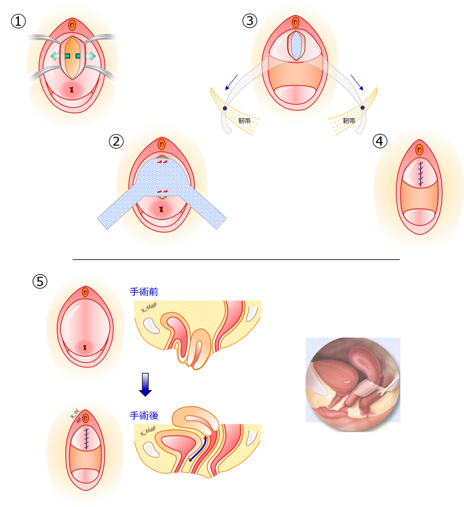 子宮脱 膀胱瘤 まとめ