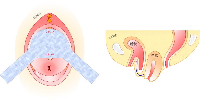 子宮脱 膀胱瘤のメッシュ手術 Tvm手術