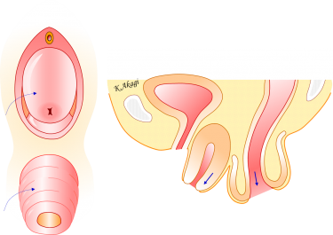 子宮脱と直腸脱の合併例