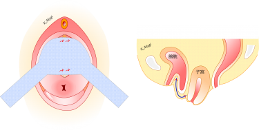 子宮脱・膀胱瘤のメッシュ手術（TVM手術）