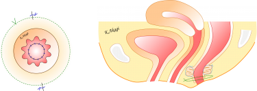 直腸脱と肛門機能障害