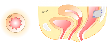 直腸脱の手術（直腸固定術）