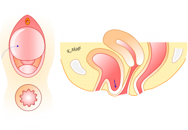 子宮脱・膀胱瘤の頻度