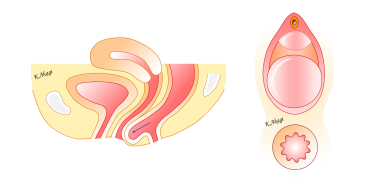 直腸瘤の手術は二種類あります。あなたに適した方法はこちら。
