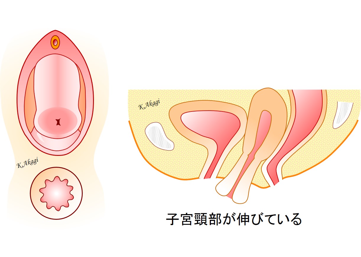二次元 子宫  脱出 