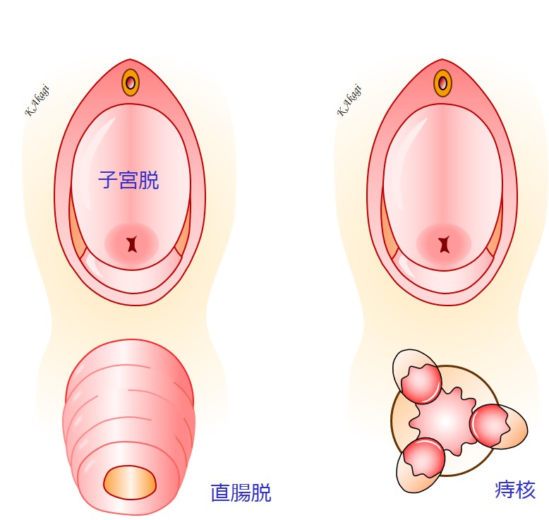 子宮脱に痔核や直腸脱を合併していても 同時に治します よくわかる骨盤臓器脱