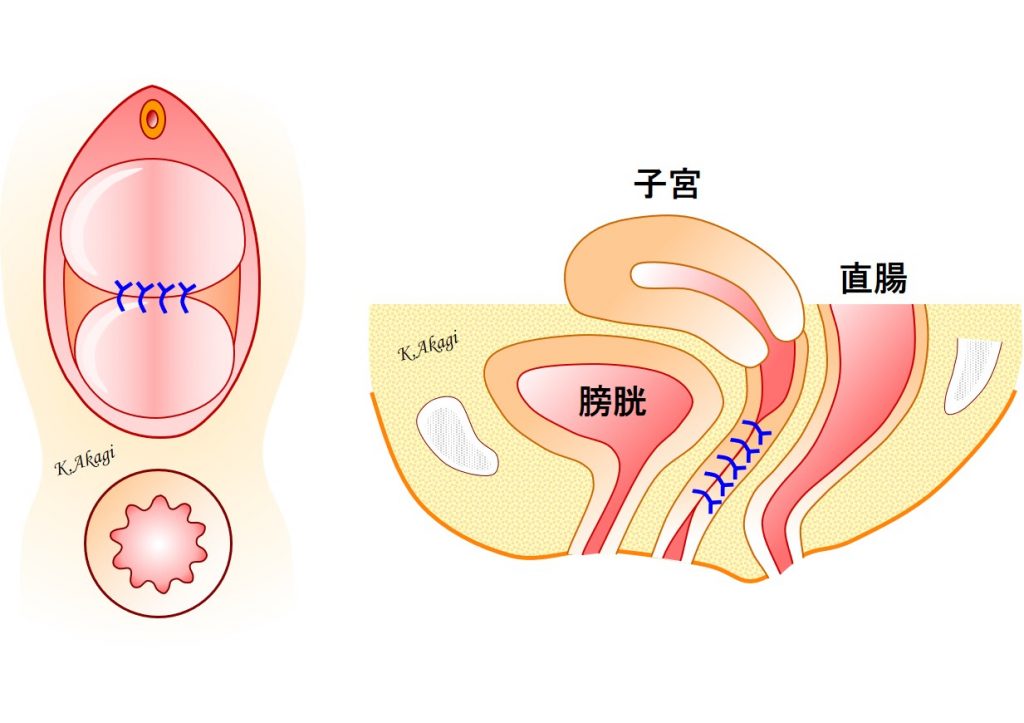 膣閉鎖症