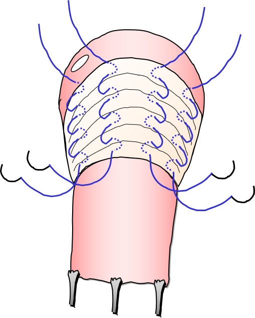 小ネタ 骨盤臓器脱の手術イラストを自作しています 楽しんでやってます よくわかる骨盤臓器脱 辻仲病院柏の葉オフィシャル