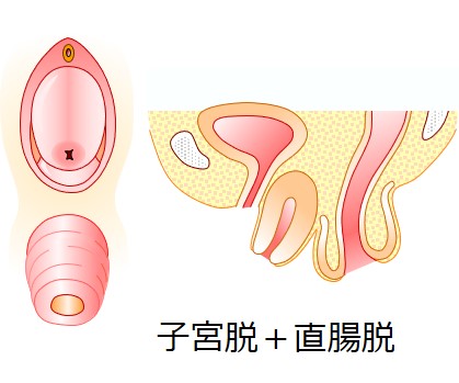 子宮脱や直腸脱の手術は高齢者でも大丈夫 90歳の方でも手術してますよ よくわかる骨盤臓器脱