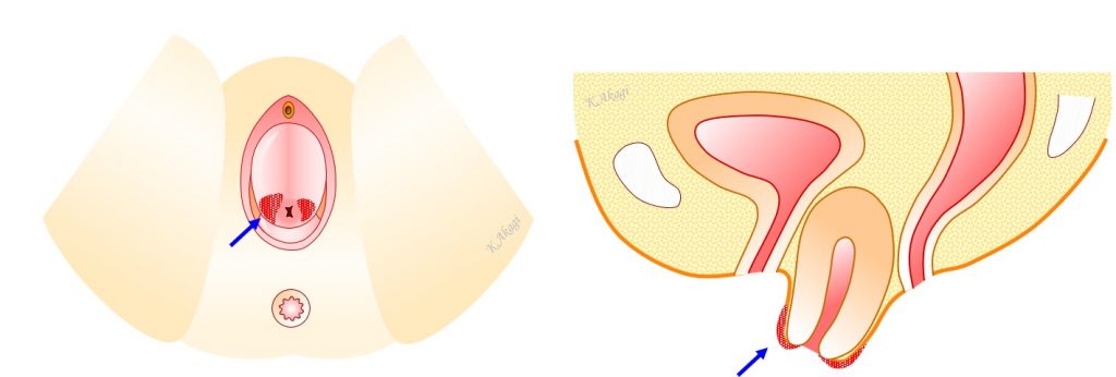 子宮脱 膀胱瘤 まとめ