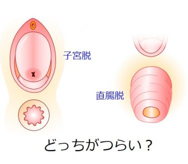 子宮脱と直腸脱はどっちがつらいの？　これはもう明らかに・・・
