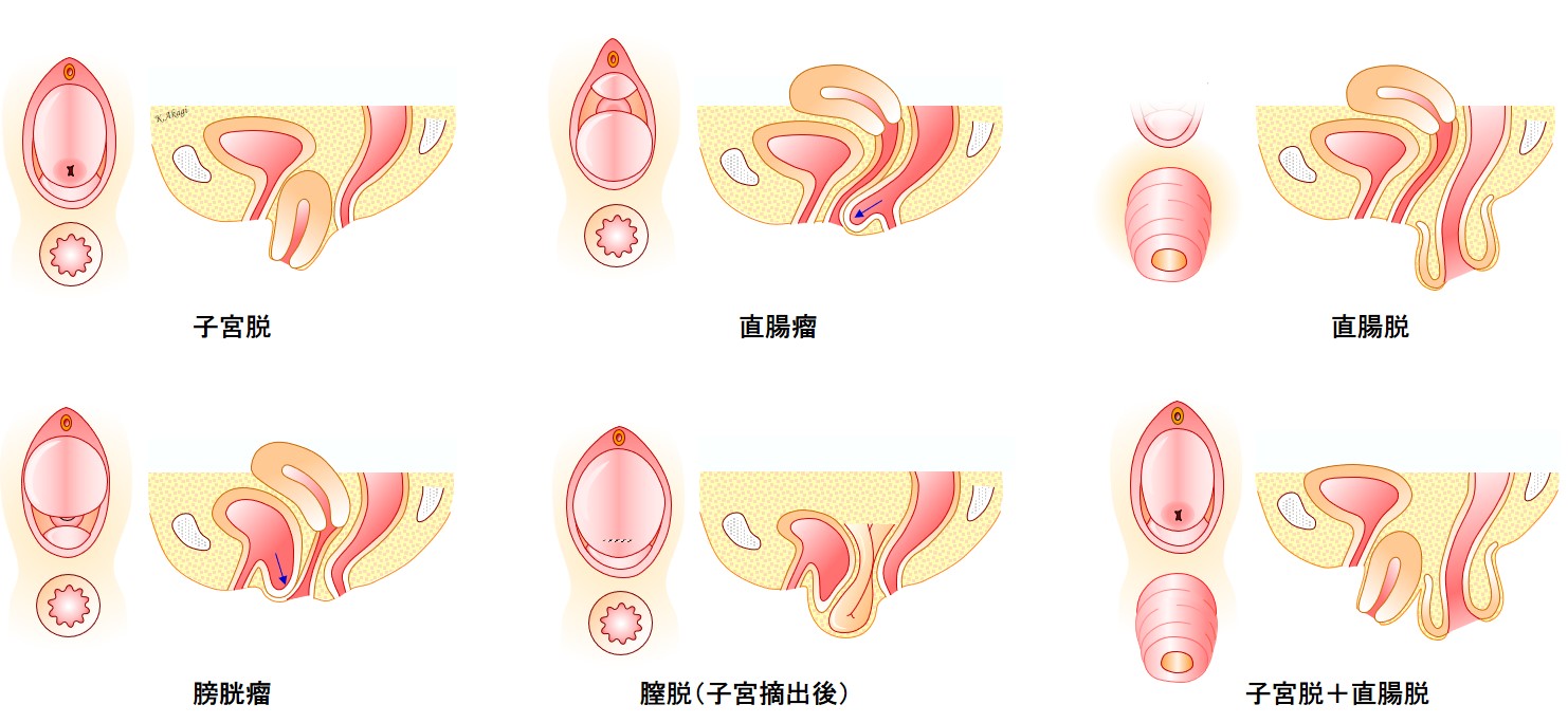 子宮脱と膀胱瘤は合併してることが多いけど いろいろ個性があるんです よくわかる骨盤臓器脱