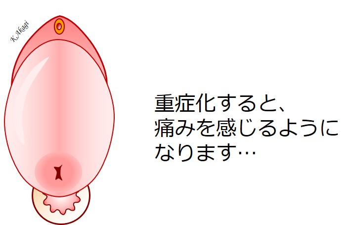 子宮脱で痛みが生じますか 腰痛はどう 手術でよくなるの よくわかる骨盤臓器脱