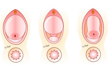 子宮脱と膀胱瘤は合併してることが多いけど、いろいろ個性があるんです。