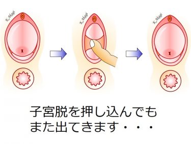子宮脱 膀胱瘤 直腸瘤 直腸脱など 骨盤臓器脱の徹底解説 よくわかる骨盤臓器脱