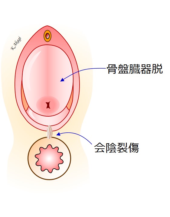 骨盤臓器脱に会陰裂傷を合併する場合の手術 よくわかる骨盤臓器脱