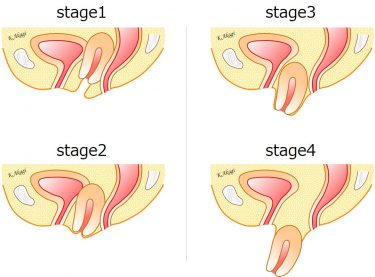 骨盤臓器脱（子宮脱膀胱瘤）のステージとは？これって何の役に立つの？